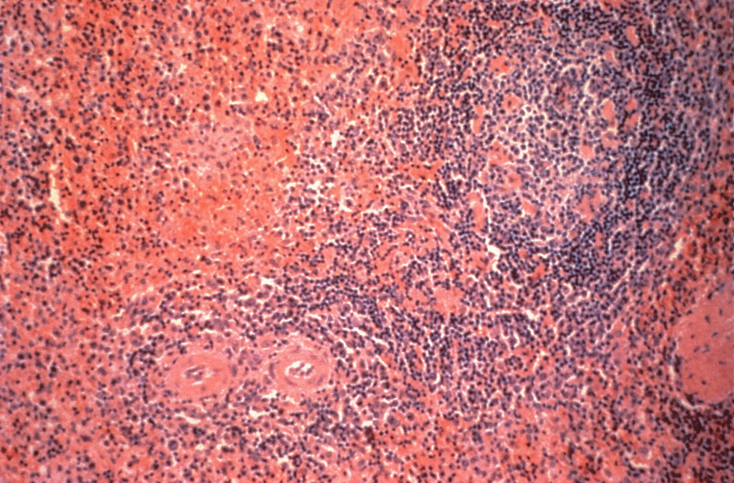 Causes of Enlarged Spleen in Adults