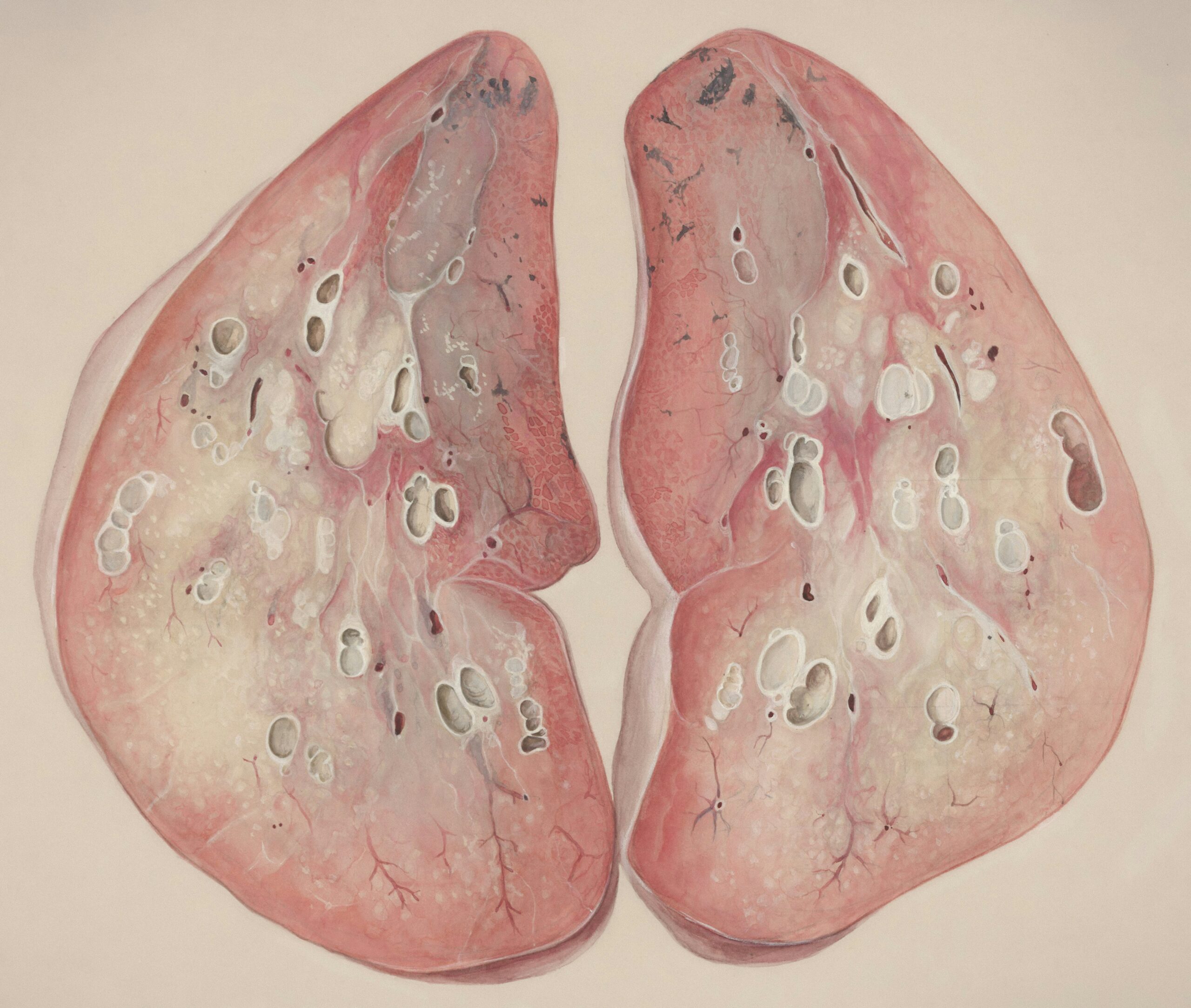 Enlarged Liver: Symptoms and Treatments